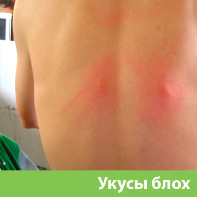 Укусы блох в Севастополе