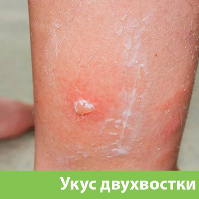 Укус двухвостки в Севастополе