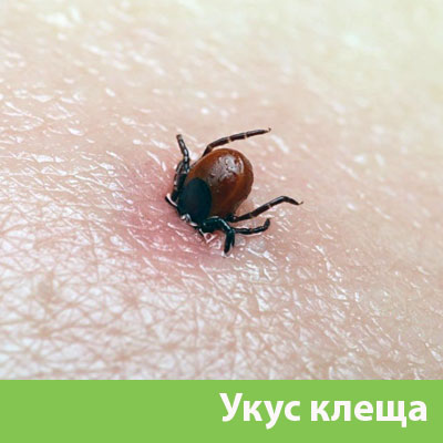 Укус клеща в Севастополе